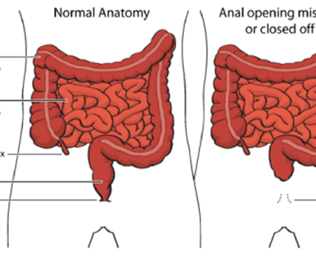 Correcting Anorectal Malformations