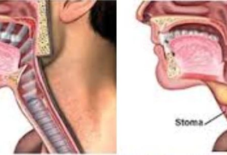 The First Total Laryngectomy At KUTRRH