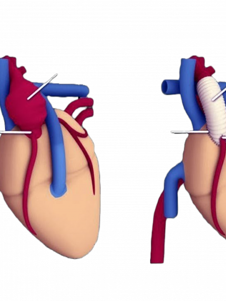 The Bentall procedure is a type of cardiac surgery involving composite graft replacement of the aortic valve, aortic root, and ascending aorta,with re-implantation of the coronary arteries into the graft. This operation is used to treat the combined disease of the aortic valve and ascending aorta. The aorta is the large blood vessel (artery) that carries blood from the heart through the chest and belly to the rest of the body. The aortic valve, which is at the base of the aorta, lets blood flow from the heart into the aorta. An aneurysm (a bulge in a blood vessel) can change the shape of the aortic valve and keep the valve from working as it should.
