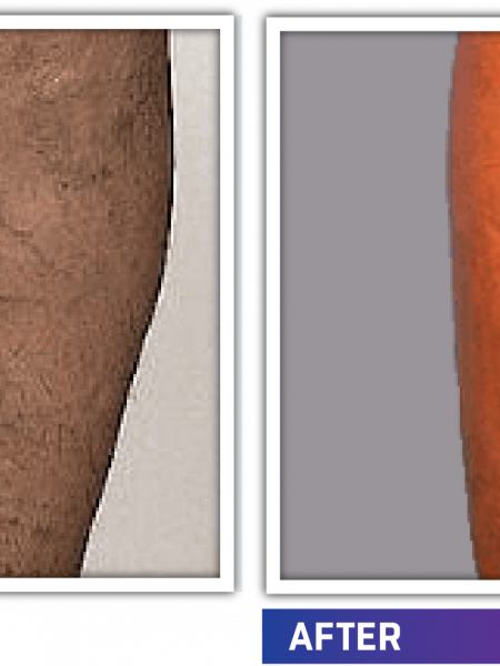 Kutrrh Hosts Varicose Veins Screening Camp