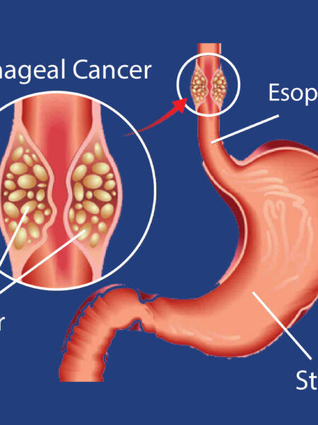 Esophageal Cancer:KUTRRH Delves into Research.