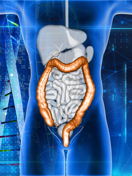 COLON CANCER