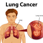Advancing Lung Cancer Care Through Early Detection and Innovative Treatment