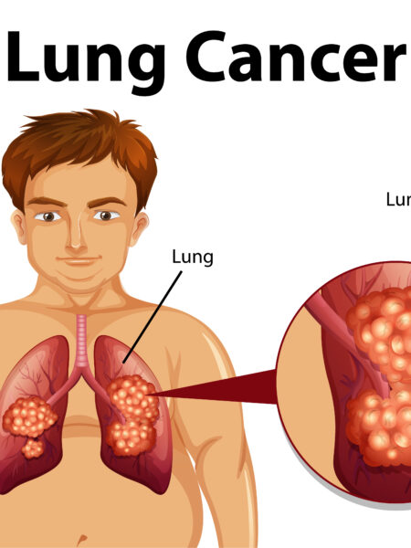 Advancing Lung Cancer Care Through Early Detection and Innovative Treatment