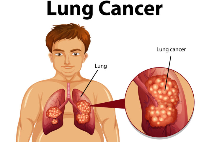 Advancing Lung Cancer Care Through Early Detection and Innovative Treatment