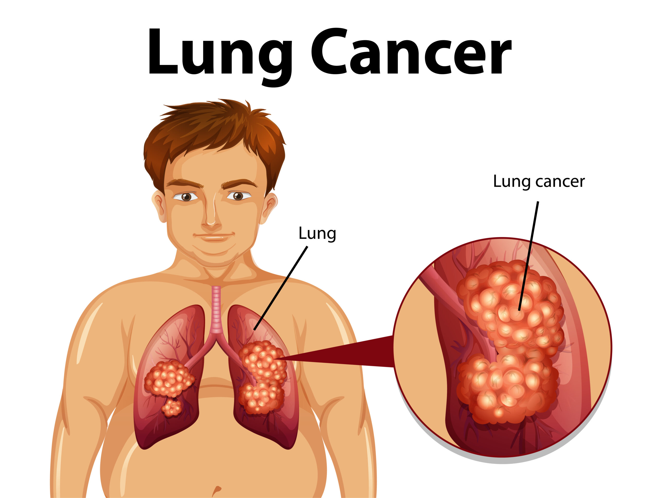 Advancing Lung Cancer Care Through Early Detection and Innovative Treatment
